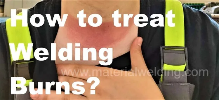 How to treat Welding Burns 1 jpg How to Treat Welding Burns?